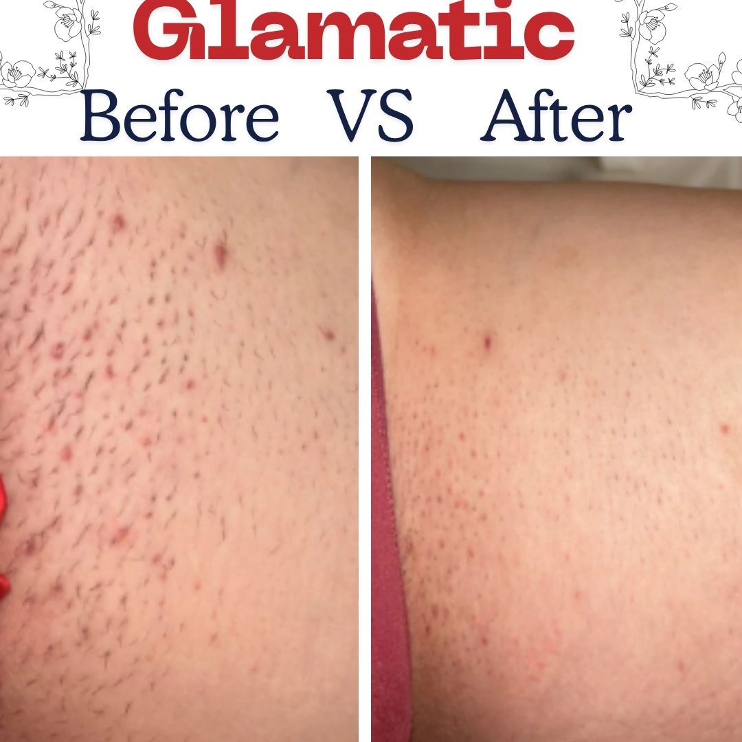 Ingrown Hair Smoothing Solution